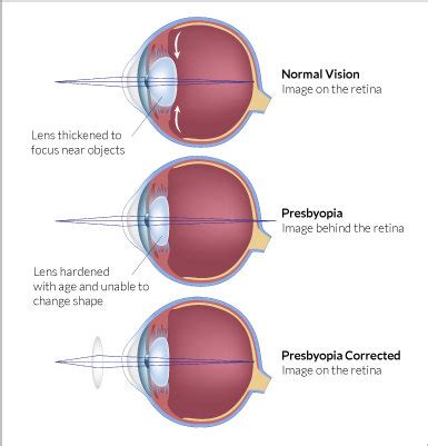 What is Presbyopia | Glasses Gallery | Eye care information