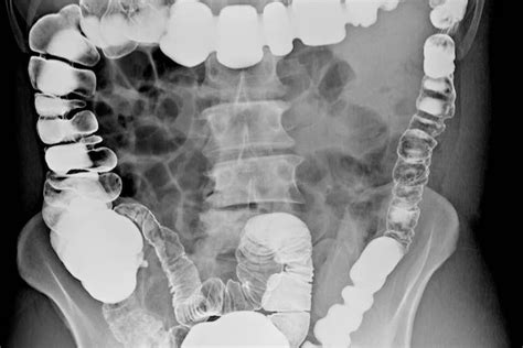 Barium enema: lower bowel examination - myDr.com.au