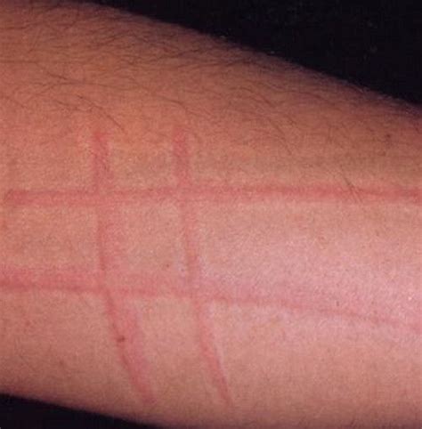 skin writing dermatographism Urticaria Dermatographia Mystery illness Severe itchy skin, hives ...