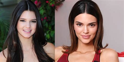 Keeping Up with the Kardashians: Kendall Jenner Plastic Surgery Facts