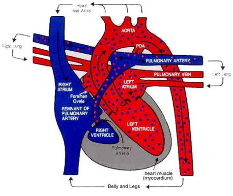 Life As A Pediatric Nurse: Hypoplastic Right Heart Syndrome