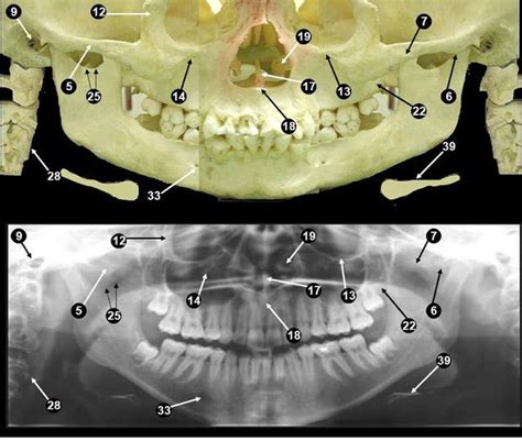 Anatomical Landmarks Of Panoramic Radiographs | Dental assistant study, Dental hygiene school ...