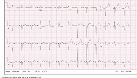 Figure 1 from Hereditary transthyretin amyloid cardiomyopathy ...