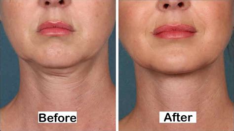 How to Get Rid of Neck Wrinkles & Neck Lines?