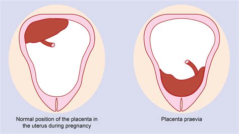 Placenta Previa Ultrasound