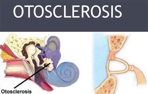 Otosclerosis causes, symptoms, diagnosis and otosclerosis treatment