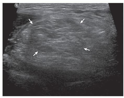 Lipoma: intramuscular. Ultrasound image shows isoechoic intramuscular ...