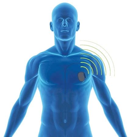 Wireless Implantable Medical Devices