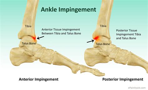 Anterior Ankle Impingement - Book In At Podiatry HQ Clinics Today!