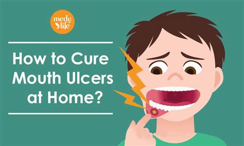 Unique Info About How To Cure An Ulcer In The Mouth - Petertrade29