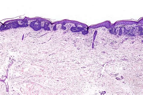 Morpheaform Basal Cell Carcinoma Histology