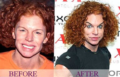 Carrot Top Plastic Surgery: Facelift, Eyebrow Lifting, Botox