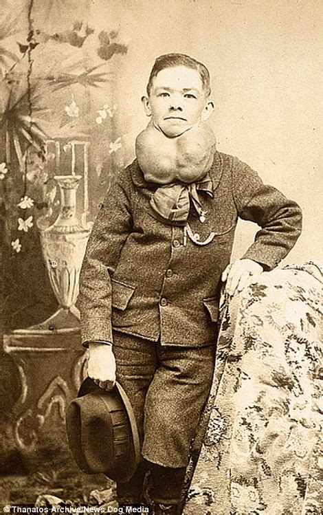 Photographic archive of 19th century deformities released | Daily Mail ...