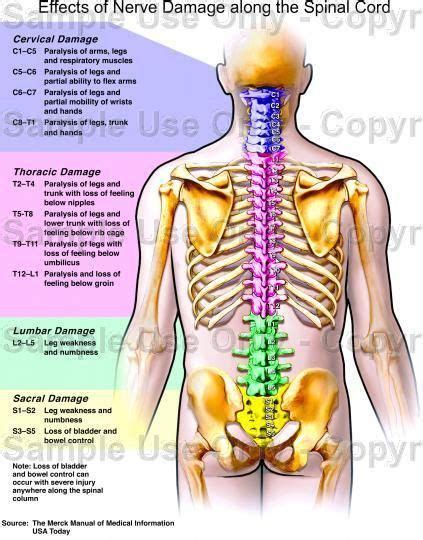 Effects of Nerve Damage along the Spinal Cord. Source; The Merck Manual of Medical Information ...