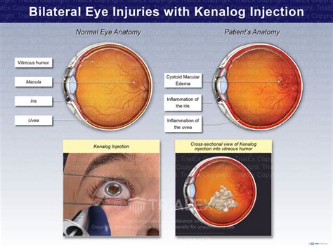 Bilateral Eye Injuries with Kenalog Injection - Trial Exhibits In...