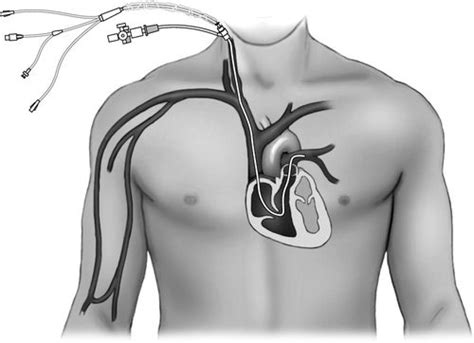 Pulmonary Artery Pressure and Thermodilution Cardiac Output Monitoring | Anesthesia Key