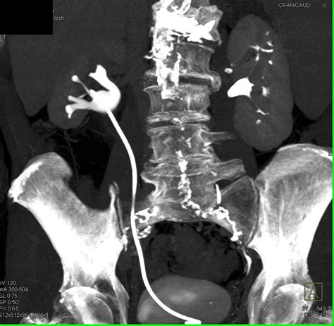 Right Ureteropelvic Junction (UPJ) with Stent in Place - Kidney Case ...