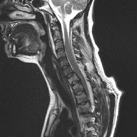 The retropulsion of bone a at the vertebral body level in a burst... | Download Scientific Diagram