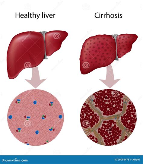 Liver Cirrhosis Royalty Free Stock Photos - Image: 29095478