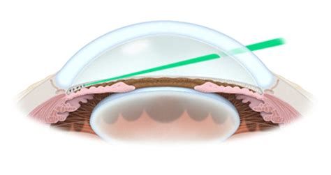 SLT Lasers | Eye & Glaucoma Surgeons