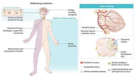 Medial Pontine Syndrome