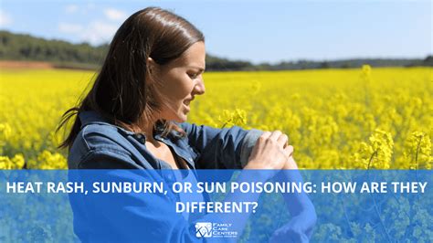 Heat Rash, Sunburn, or Sun Poisoning: How Are They Different?