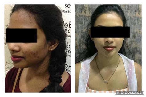 Glutathione Skin Whitening & Hair Treatment Before & After Results