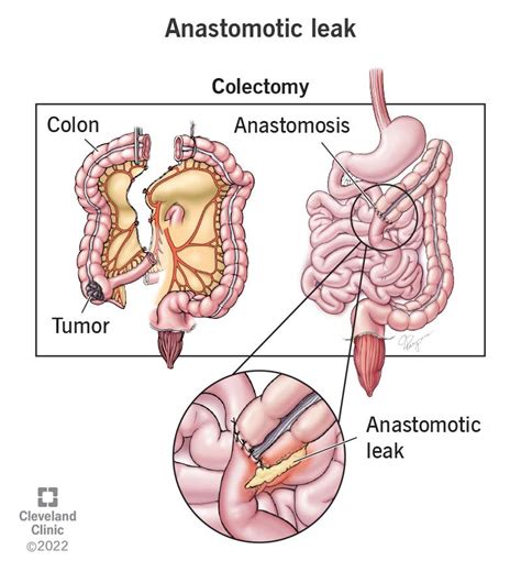 Anastomotic Leak: Symptoms, Treatment & What It Is