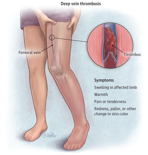 Pain Behind The Knee : Causes, Picture, Symptoms And Treatment