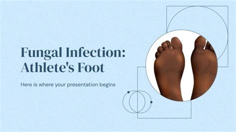 Fungal Infection: Athlete's Foot | Google Slides & PPT