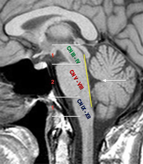 Cross Sectional Anatomy Mri Brain Sagittal Anatomy