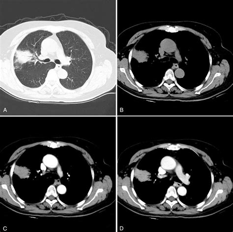 (A) Transverse lung CT shows consolidation of the right upper lung and... | Download Scientific ...