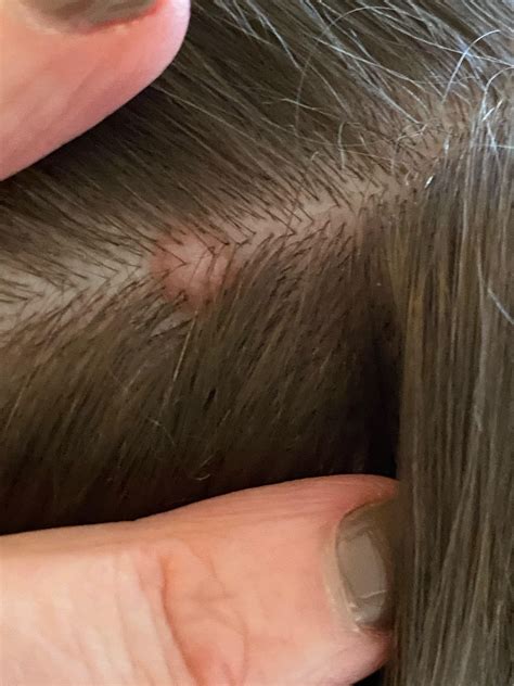 Red/Pink Mole on Scalp : r/Melanoma