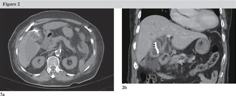 Table 1 from Route Selection for Percutaneous Cholecystostomy, Concerning Complications and ...