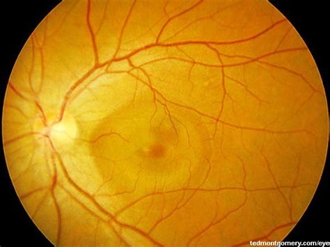 Central Serous Chorioretinopathy: #1