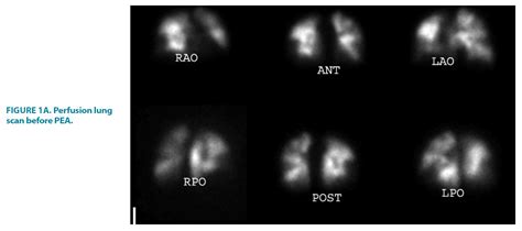 Perfusion lung scan after pulmonary artery endarterectomy in patients with chronic ...