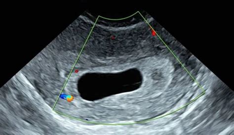 Blighted Ovum (Anembryonic Pregnancy): Causes & Symptoms (2022)