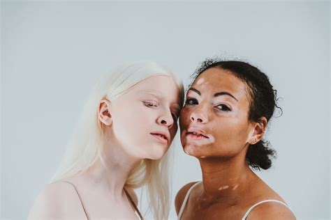 Vitiligo vs. Albinism: What’s the Difference?