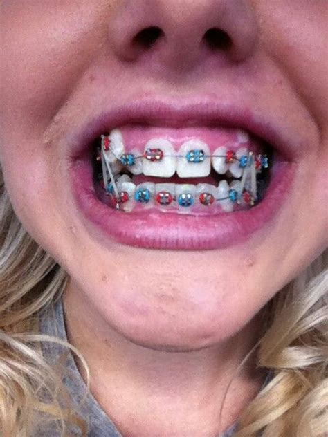 1st day with braces | Cute braces colors, Braces colors, Cute braces