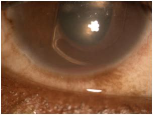 Uveitis-Glaucoma-Hyphema (UGH) syndrome-a complex complication - MedCrave online