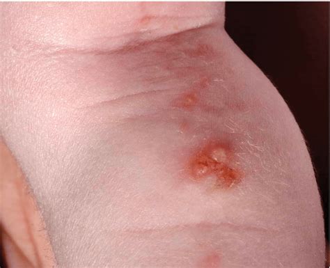 Spongiotic Dermatitis: Symptoms, Treatment & Prevention