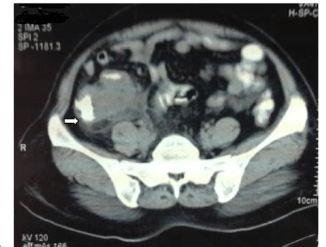 CT scan showing appendicular lump. Arrow showed an ill-defined... | Download Scientific Diagram