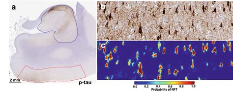 Detection of neurofibrillary tangles (NFT) in phospho-tau (AT8 ...