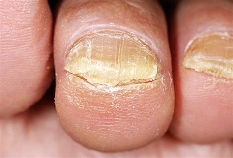 Toenail Fungus or Fungal Nails - want to know how to manage them?