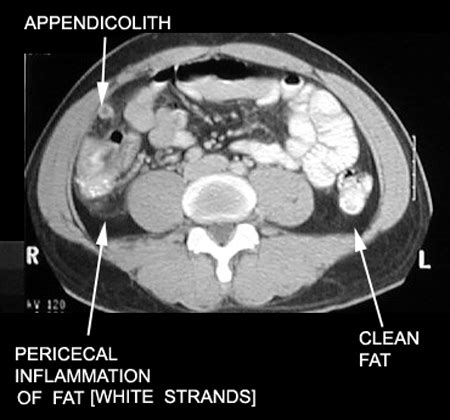 Appendicitis