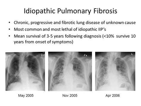 Αποτέλεσμα εικόνας για idiopathic pulmonary fibrosis x ray findings