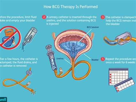 An Instillation Procedure Of The Bladder Is Performed For Treatment Of ...