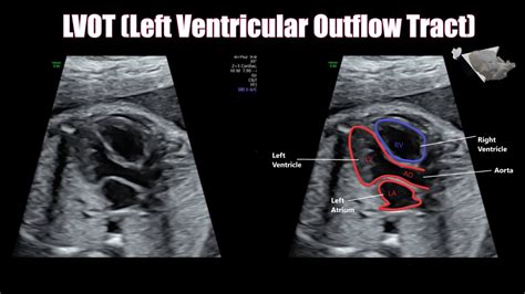 Fetal Lvot Ultrasound