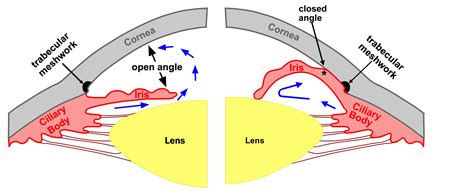 Ch 4 Types of Glaucoma. A Patient's Guide to Glaucoma