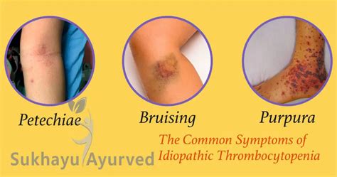 Ayurvedic Treatment for Immune thrombocytopenia: Vaidya Dr. Pardeep